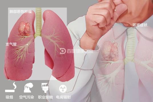 肺癌（病症）