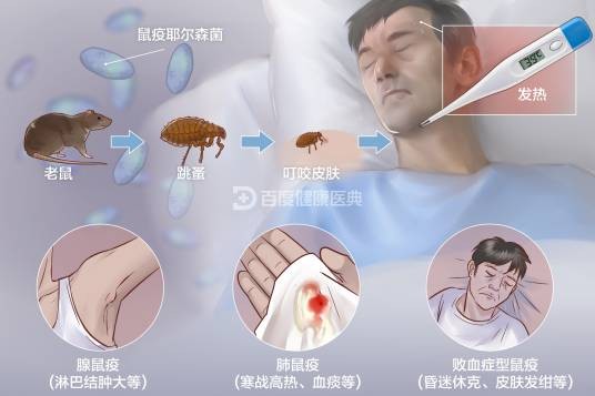 鼠疫（鼠疫耶尔森菌借鼠蚤传播为主的烈性传染病）