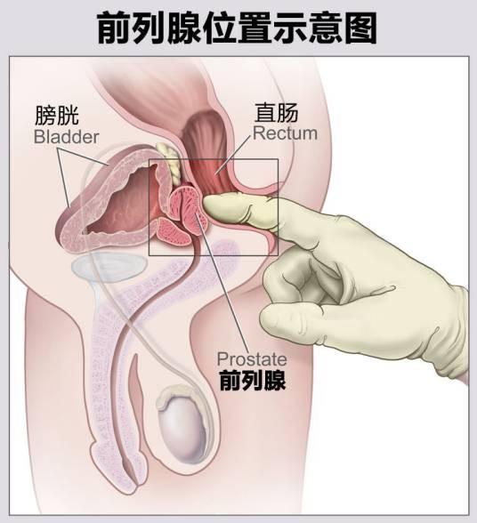 痔-前列腺肥大-阳痿综合征