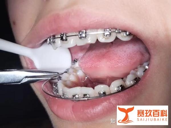 东莞口腔牙齿矫正多少钱价格表2024,怎么选择可靠的正畸医生?