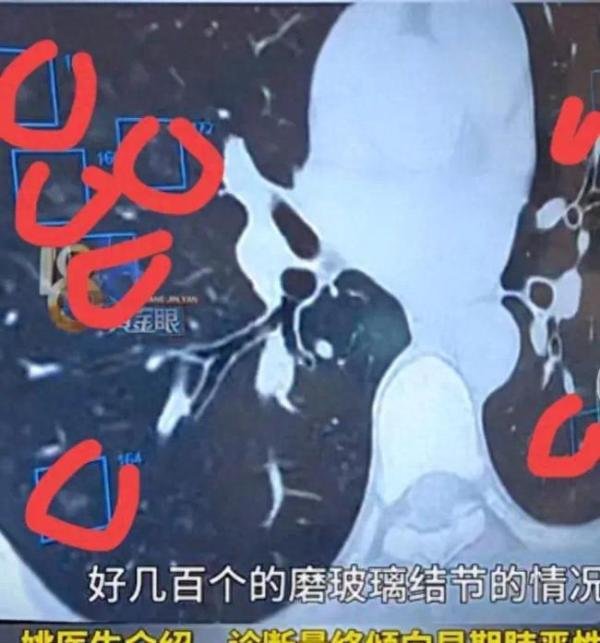 浙江37岁男子查出557个肺结节，医生：表示震惊！