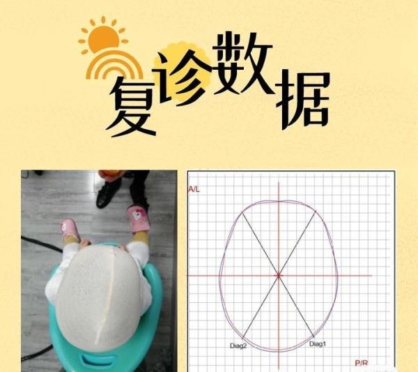 先天性颅缝早闭+舟状头+先天心脏病,这个头型矫正案例太特殊