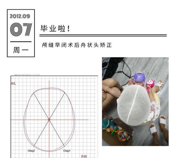 先天性颅缝早闭+舟状头+先天心脏病,这个头型矫正案例太特殊