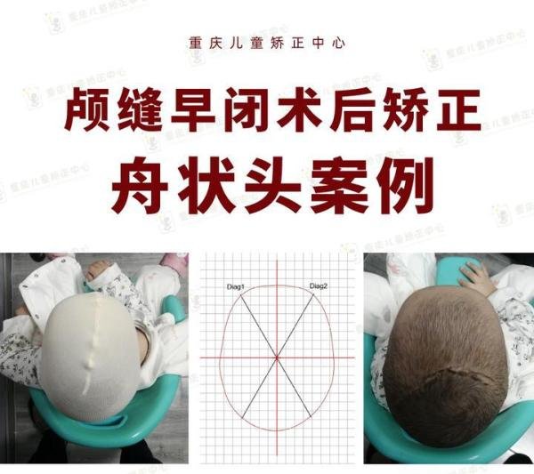 先天性颅缝早闭+舟状头+先天心脏病，这个头型矫正案例太特殊