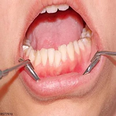 后牙反合严重吗