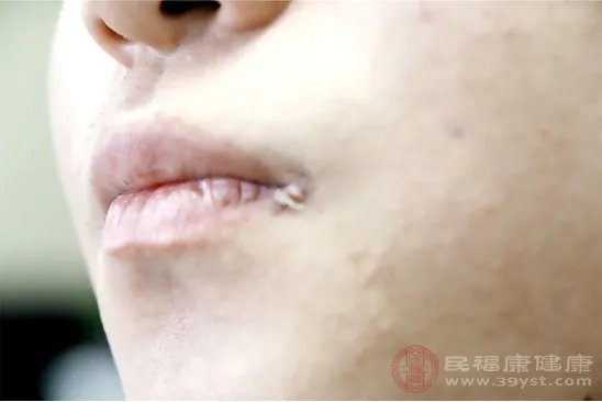 嘴角起泡怎么办