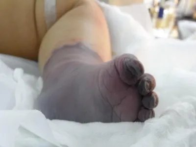 新生儿皮下坏疽症状图片