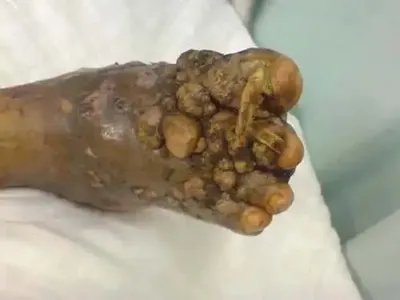 足菌肿症状图片