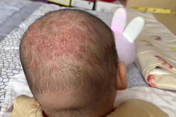 面部脂溢性皮炎症状图