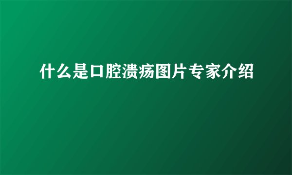 什么是口腔溃疡图片专家介绍