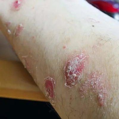 吃什么中药能治牛皮癣