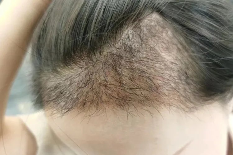 植发恢复过程图片