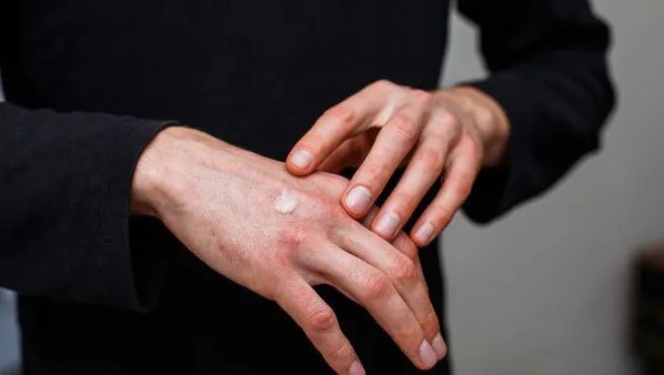 蚊子咬了怎么消肿止痒最快