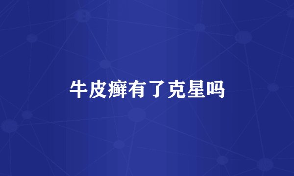 牛皮癣有了克星吗