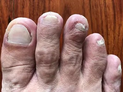 远端侧位甲下型甲真菌病脚趾甲缩小图片