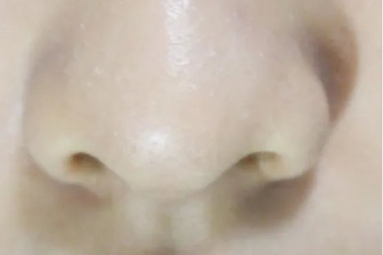 如何改善大鼻头