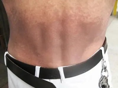 焦油性黑变病腰部斑图片