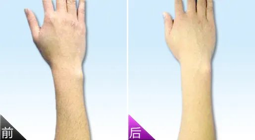冰点脱毛费用